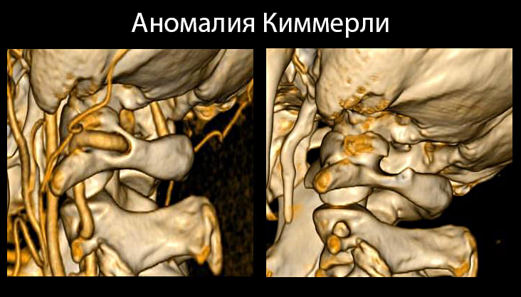 Аномалия Киммерле