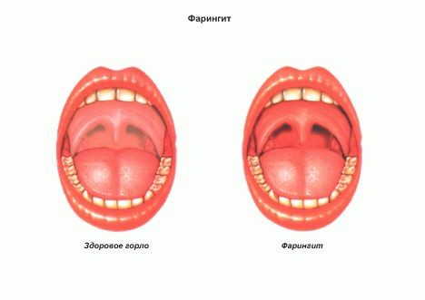 фарингит