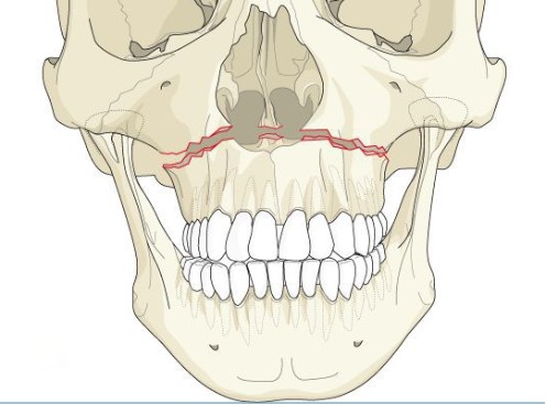 Переломы верхней челюсти