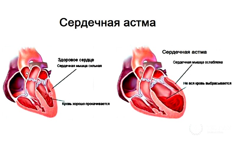 причины сердечной астмы