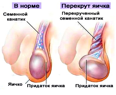 перекрут яичка