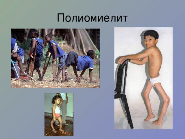 полиомиелит