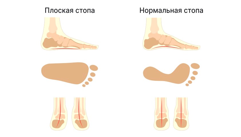плоскостопие