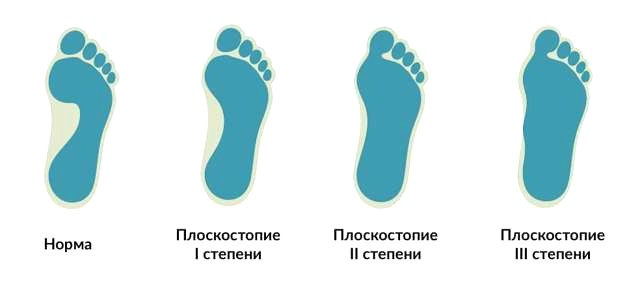 плоскостопие