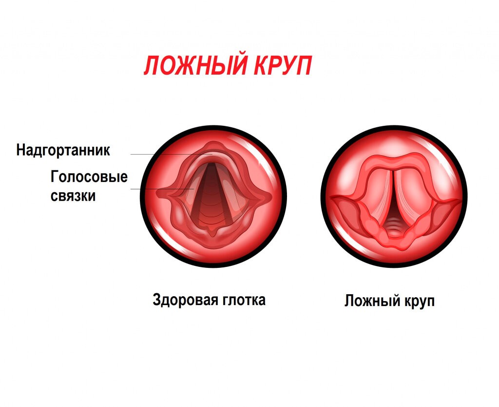 ложный круп
