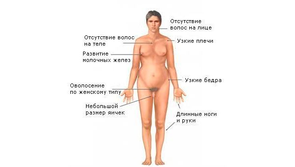 кляйнфельтера