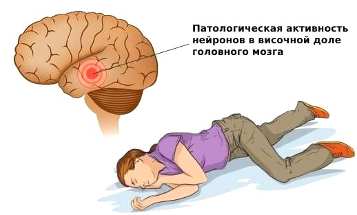 эпилепсия