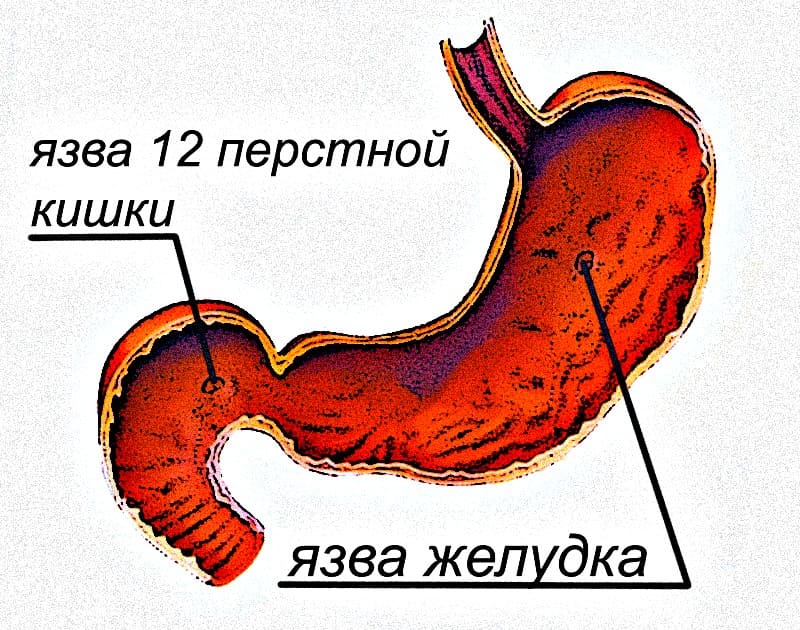 гастрит и язва
