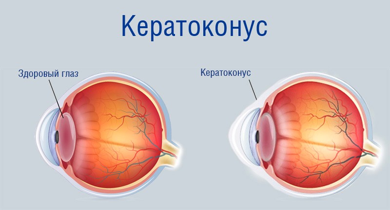 кератоконус