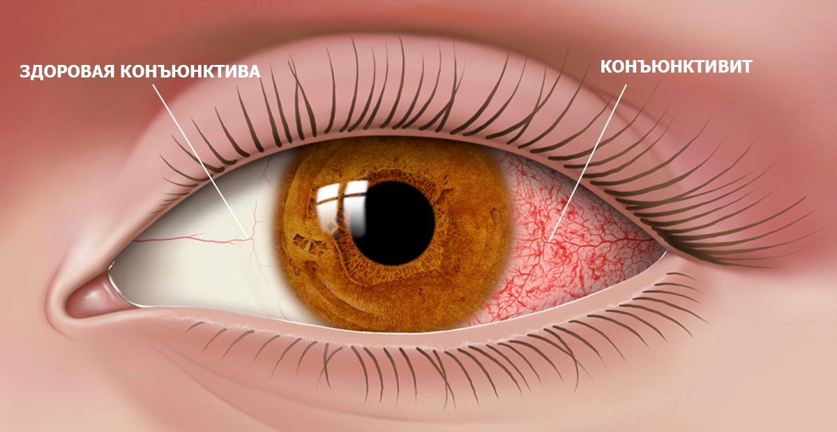конъюнктивит