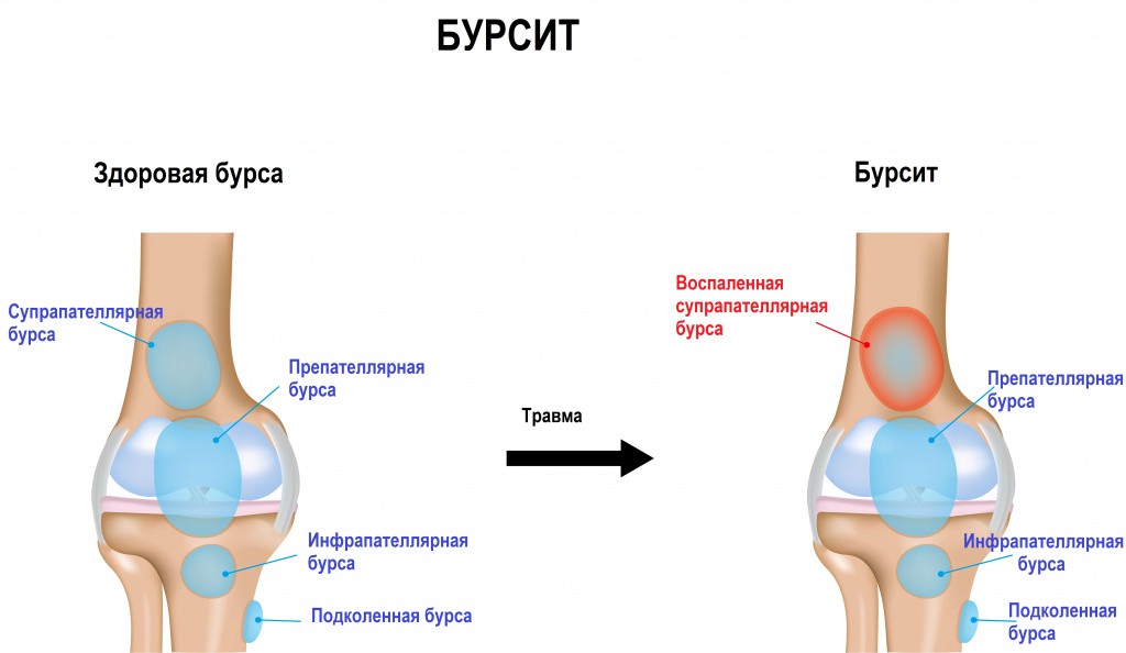 Бурсит локтевого сустава фото лечение симптомы Бурсит коленного сустава - Arimed