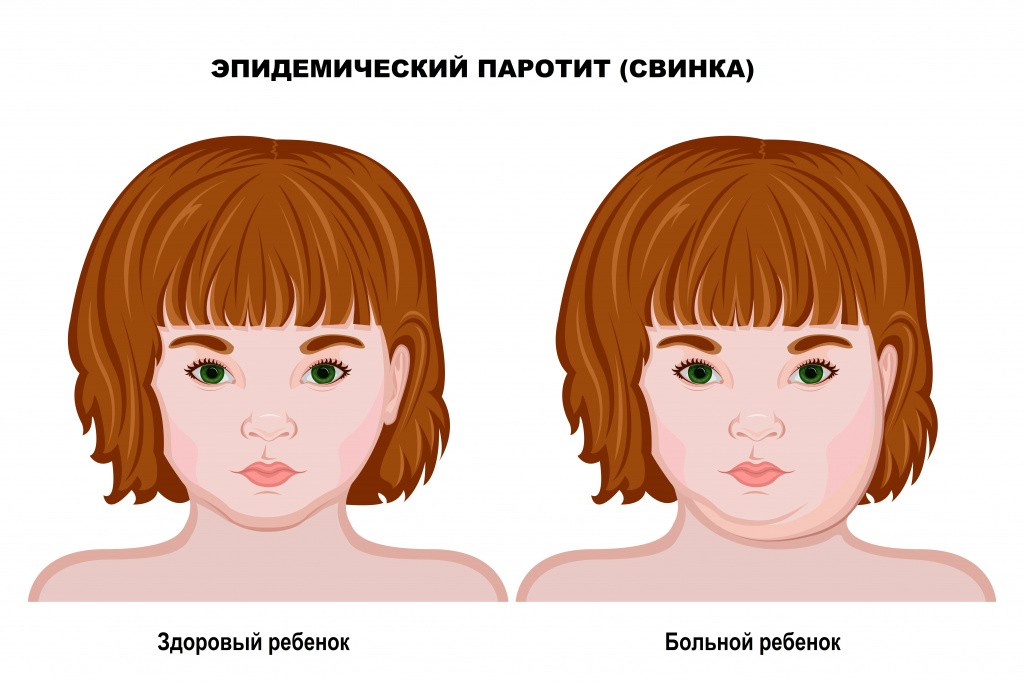 свинка