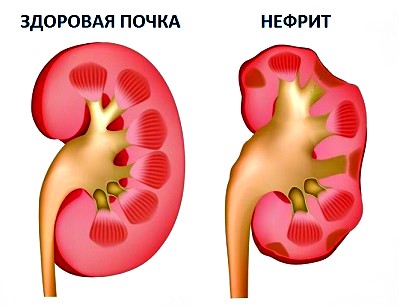 причины нефрита