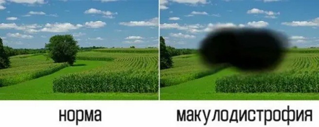 макулодистрофия