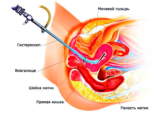 биопсия