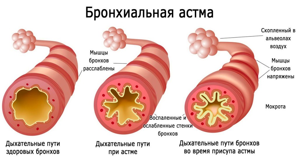 астма