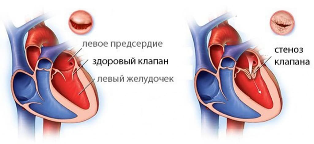 митральный стеноз