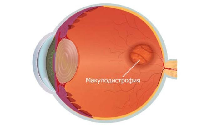 макулодистрофия