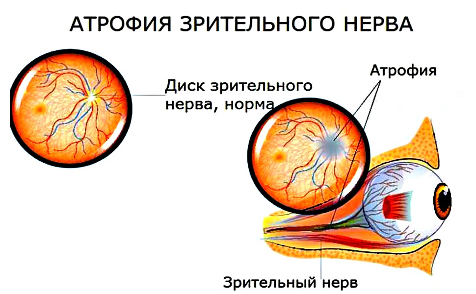 причины атрофии