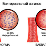 Бактериальный вагиноз при беременности Arimed