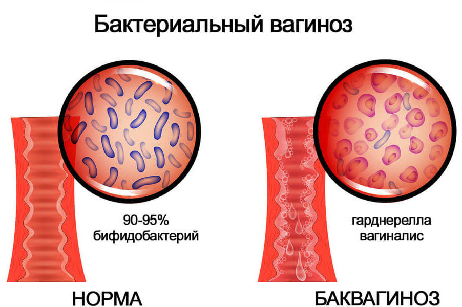 Бактериальный вагиноз при беременности Arimed