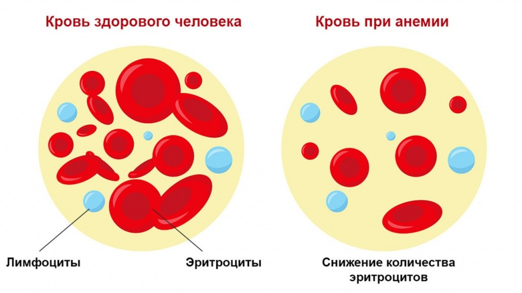 анемия