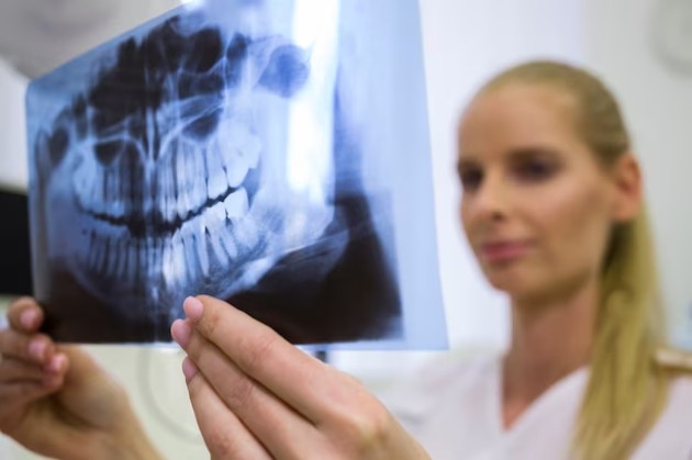Остеорадионекроз челюстно-лицевых костей