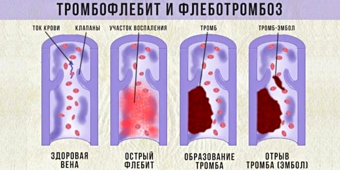 Как выглядит кровь под кожей Почему повышены Д-димеры - Arimed