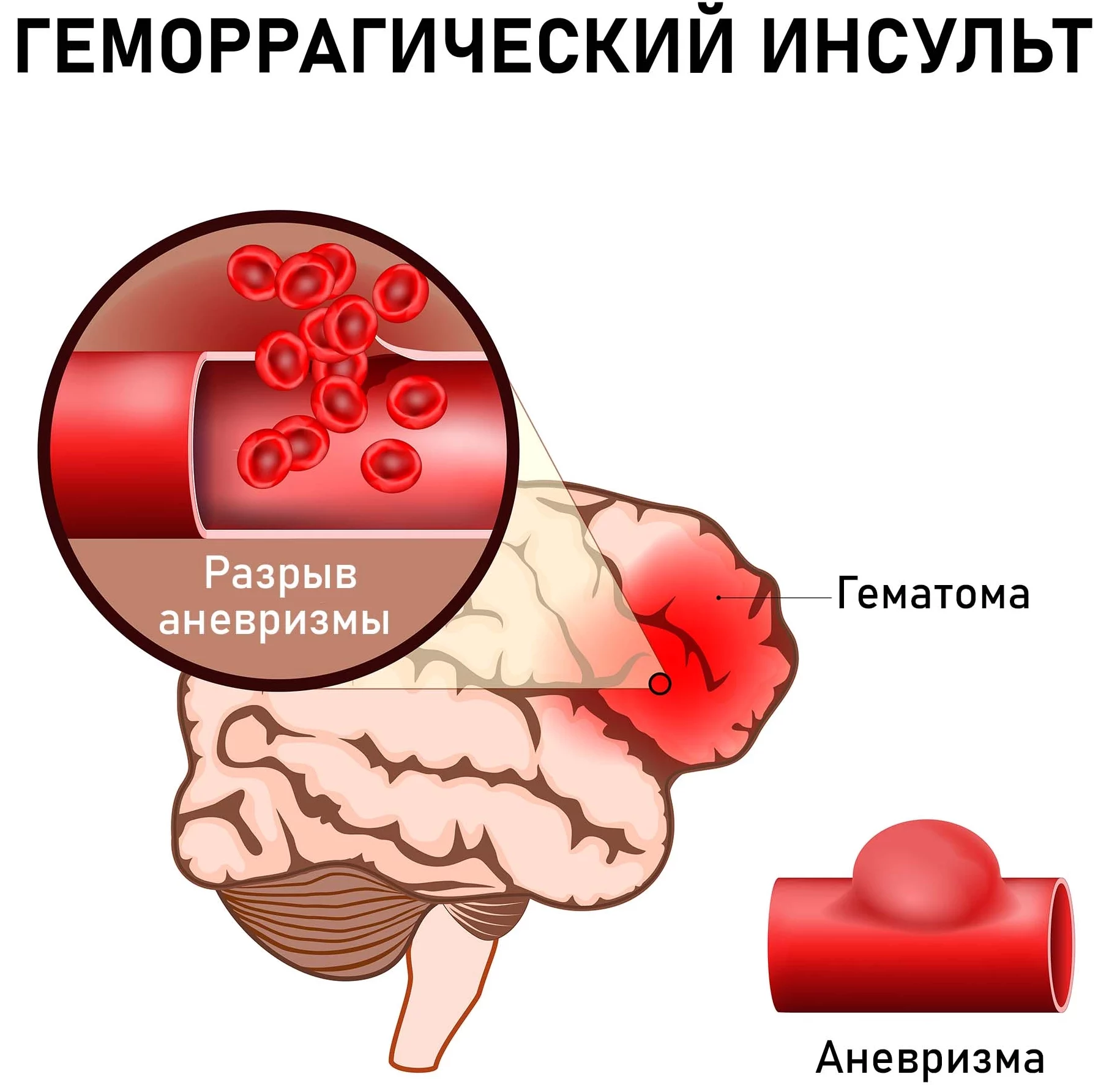 Геморрагический инсульт Arimed