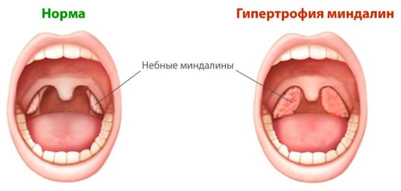 гипертрофия