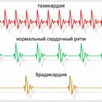 Почему в покое беспокоит тахикардия Arimed