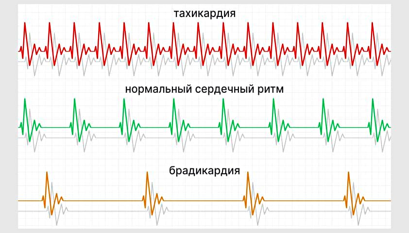 Почему в покое беспокоит тахикардия