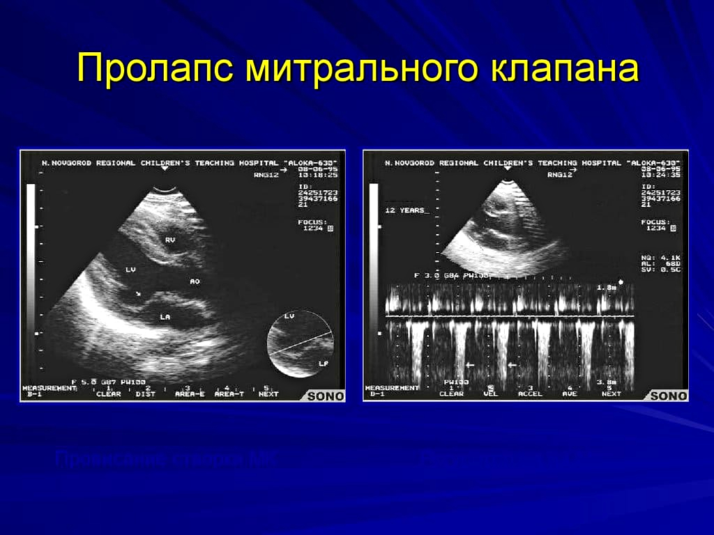 Признаки пролапса митрального клапана