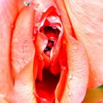 Крауроз вульвы Arimed