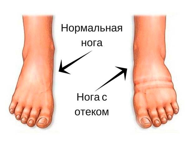 отеки