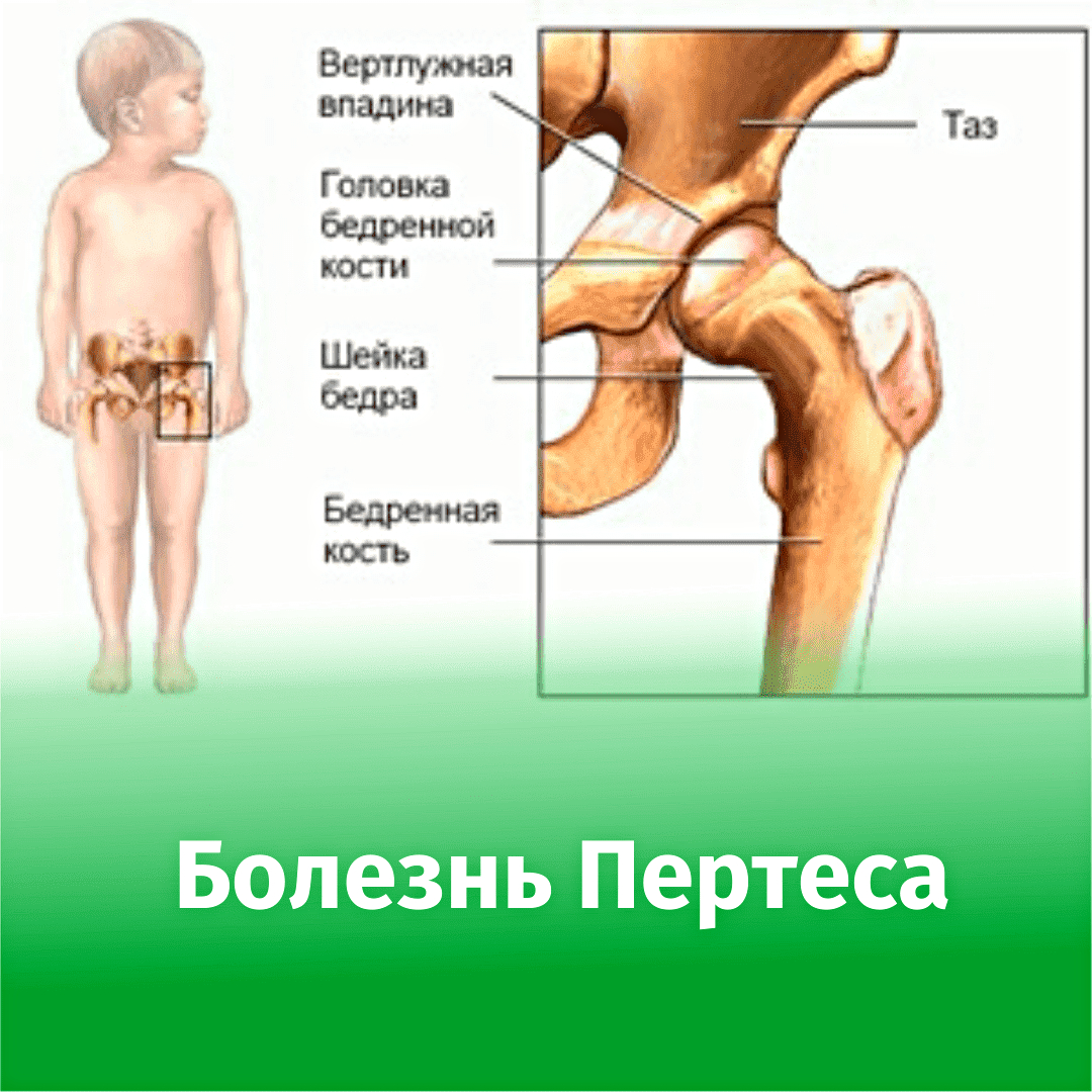 Болезнь Пертеса тазобедренного сустава. Болезнь Легга Кальве Пертеса. Юношеский остеохондроз головки бедренной кости Легга-Кальве-Пертеса. Болезнь Пертеса тазобедренного сустава у детей симптомы.