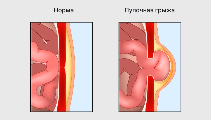 грыжа