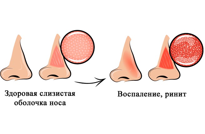 ринит
