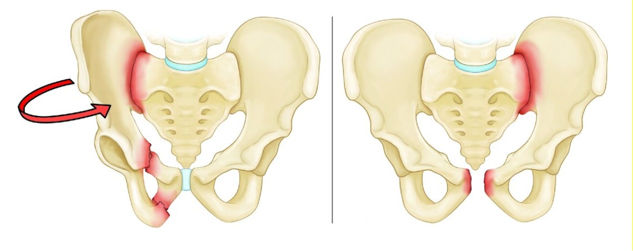 Перелом лобковой кости Arimed