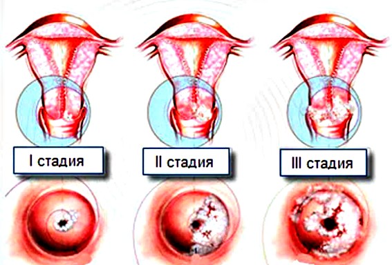 лейкоплазия стадии