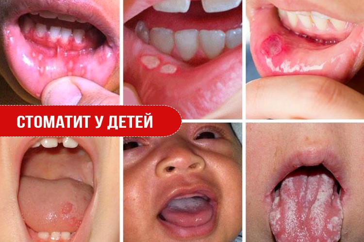 стоматит