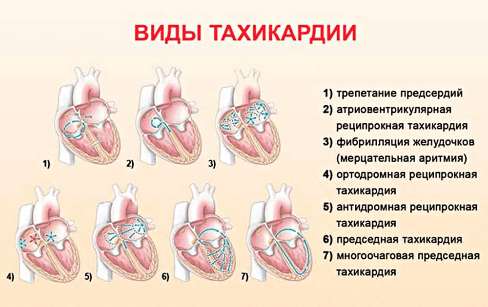 Тахикардия. Тахикардия сердца. Учащенное сердцебиение тахикардия. Болезнь сердца тахикардия.