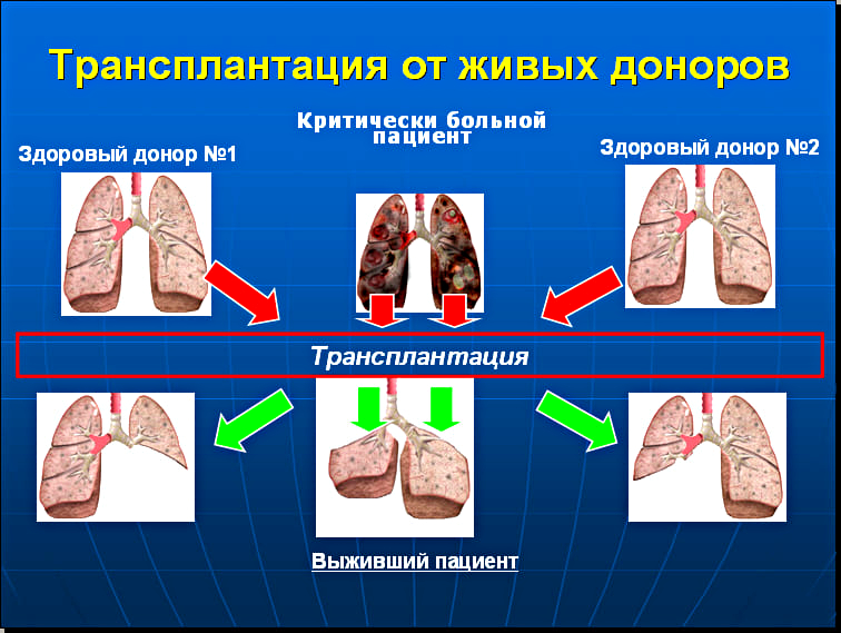 Стоимость Пересадки Легких