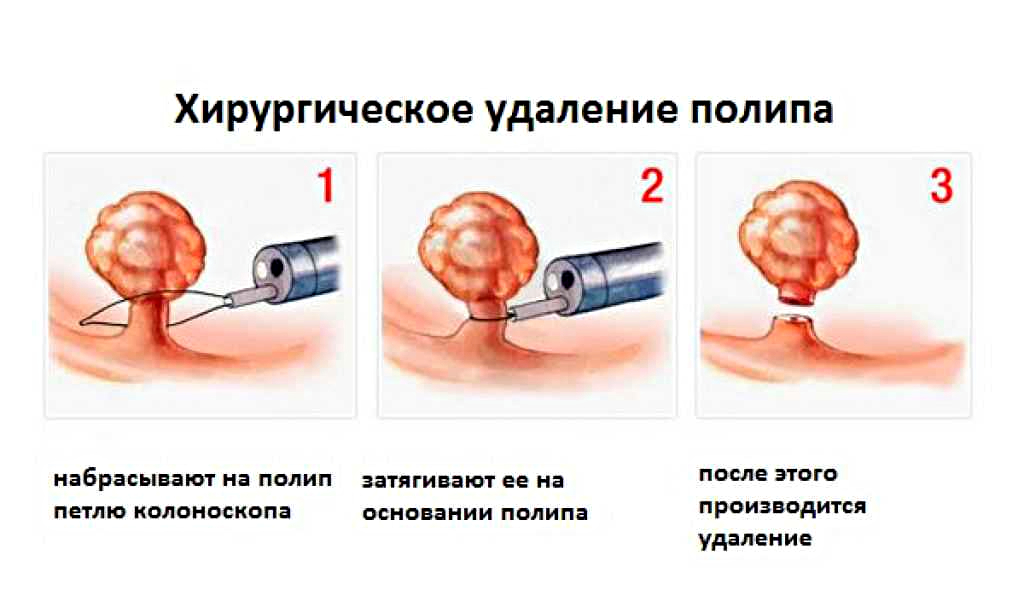 Выскабливание матки удаление полипов. Радиоволновый нож для удаления полипа матки. Хирургические методы лечения шейки матки. Полип матки при гистероскопии. Полип эндометрия в матке операция.