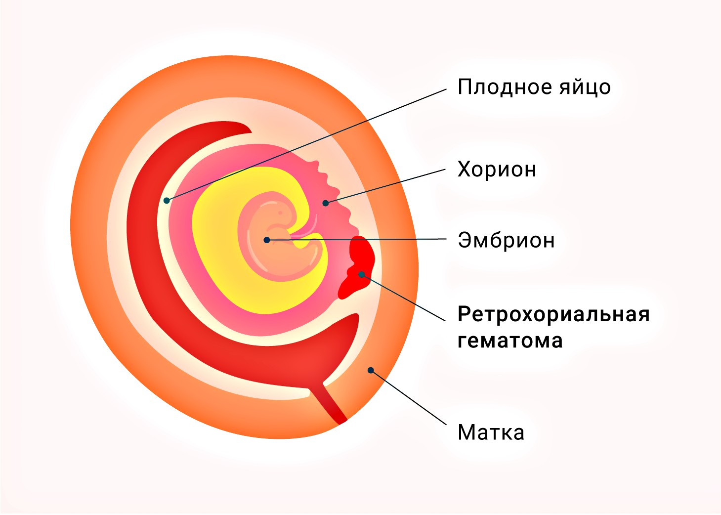 что такое ретрохориальная гематома