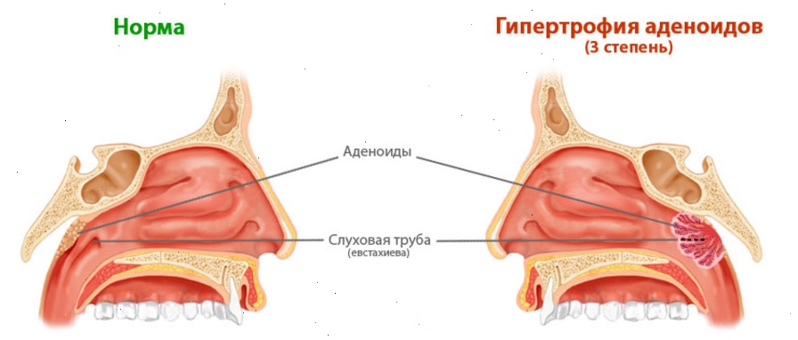 Аденоидит