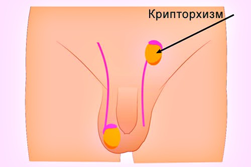 Крипторхизм врожденный