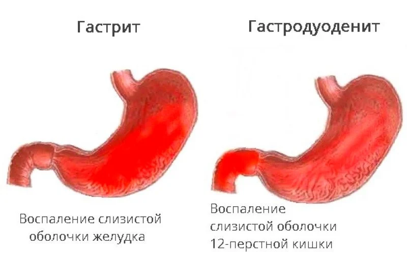 гастродуоденит