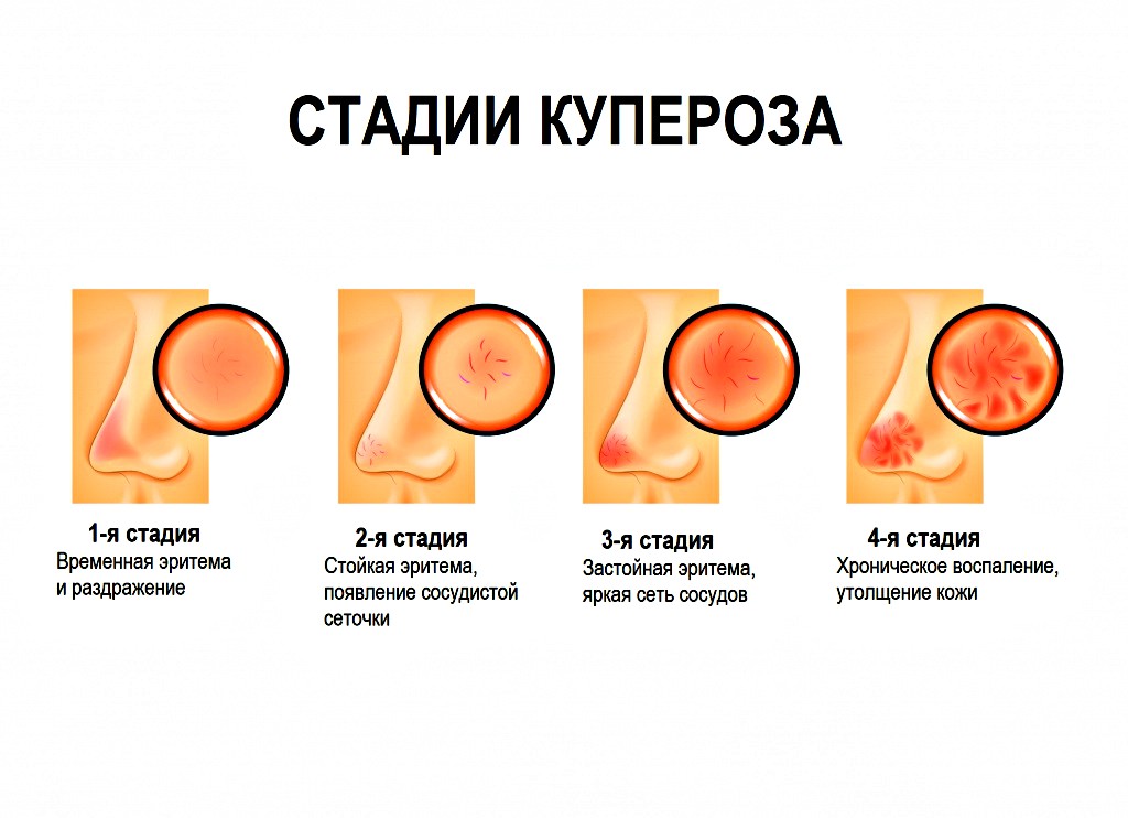 стадии купероза