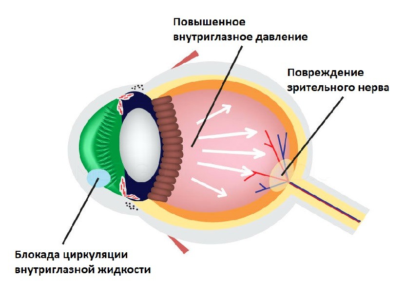 Понижение внутриглазного давления. Глаукома схема. Глаукома схема глаза. Глаукома строение глаза.